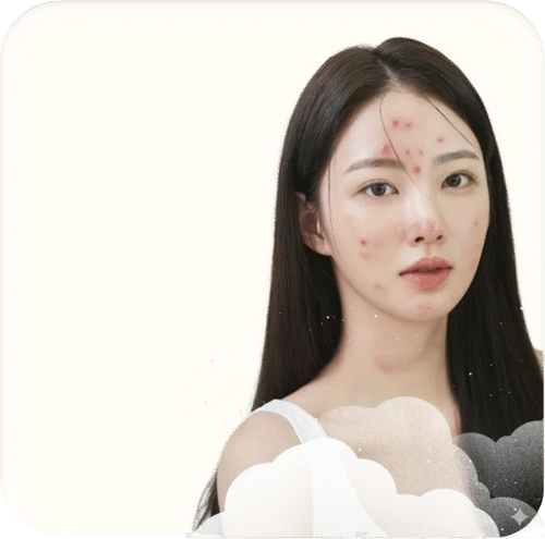 Acne & Blemishes