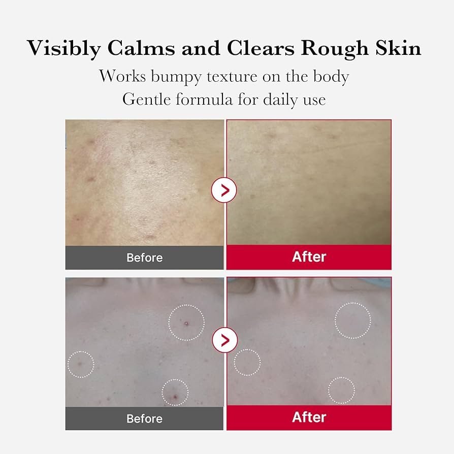 Medicube Red Acne Body Peeling Shot Spray Cleanser